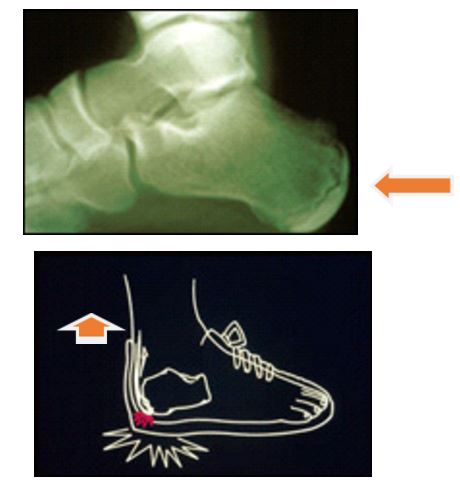 Apophysitis and Osteochondrosis: Common Causes of Pain in Growing Bones |  AAFP