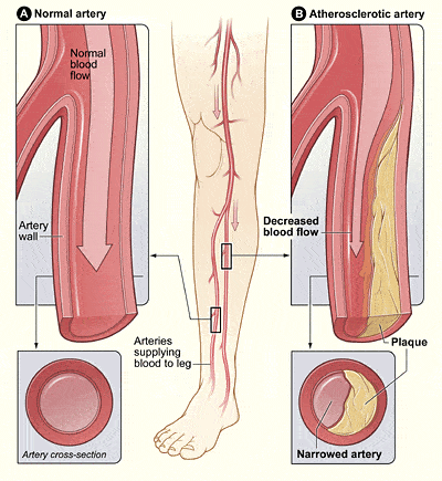 Peripheral Arterial Disease Podiatrists