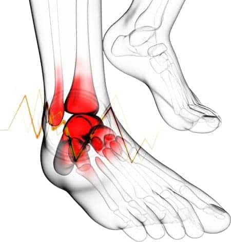 Illustration of an ankle fracture