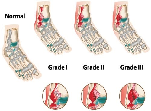 Illustration showing the different stages of an ankle sprain