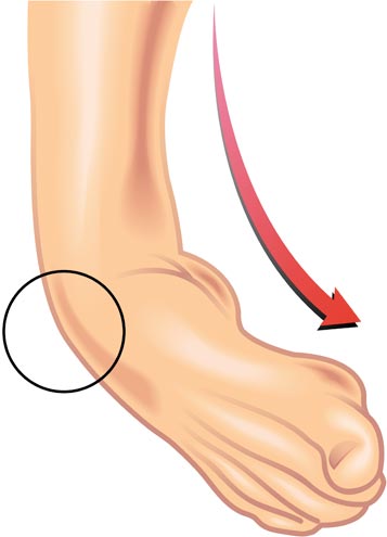 Illustration showing an ankle strain