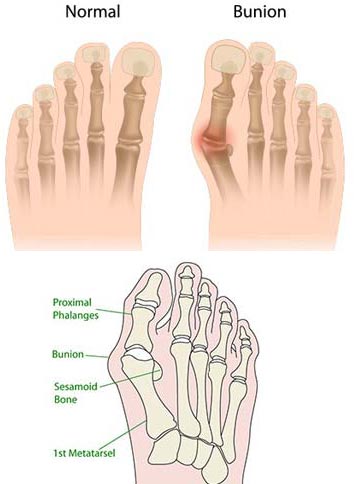 Illustration showing what a bunion looks like