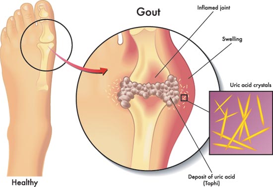 Illustrative comparison of healthy and gout-infected feet