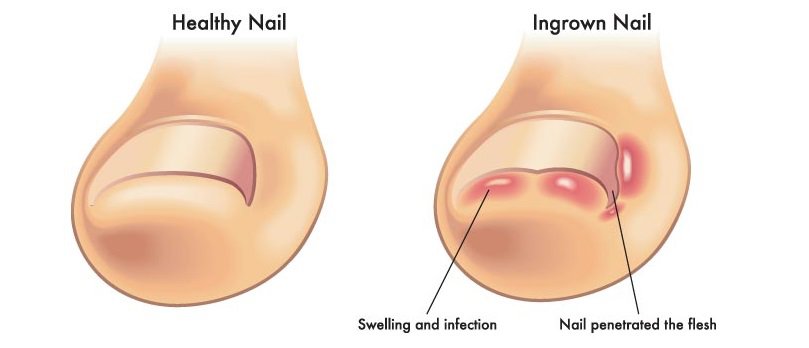 Illustrations comparing healthy and ingrown toenails