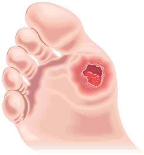 Illustration of foot ulcer