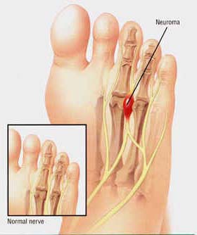 Illustration showing a neuroma