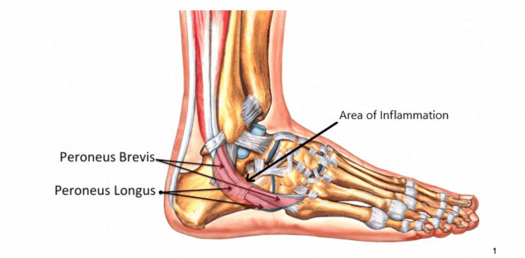 Peroneal Tendonitis foot injury and foot pain.